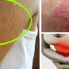 Nietolerancja glutenu i laktozy: objawy, diagnostyka i jak odróżnić