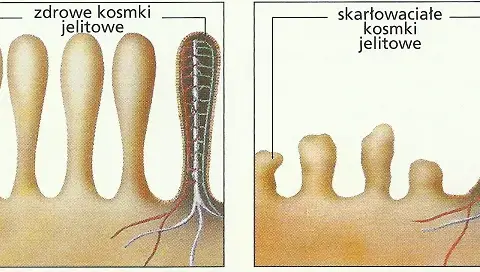 Nietolerancja glutenu: objawy, różnice, diagnoza i dieta
