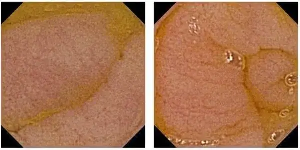 biopsja jelita cienkiego endoskopia