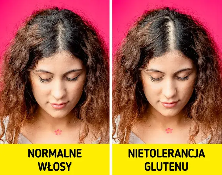 objawy pozajelitowe nietolerancji glutenu